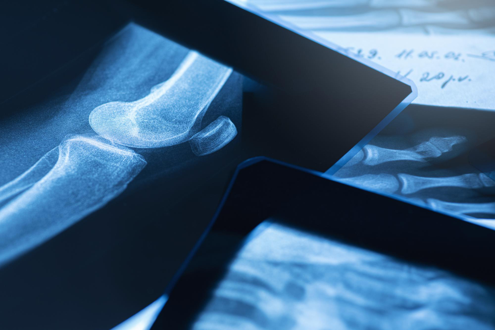 iit-g-creates-ai-driven-model-for-predicting-knee-osteoarthritis-severity-using-x-ray-images